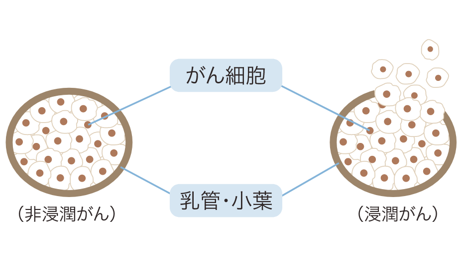 乳がんイメージ２